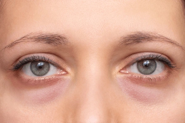 Cause of dark undereye