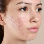 What are the cause of face pimples