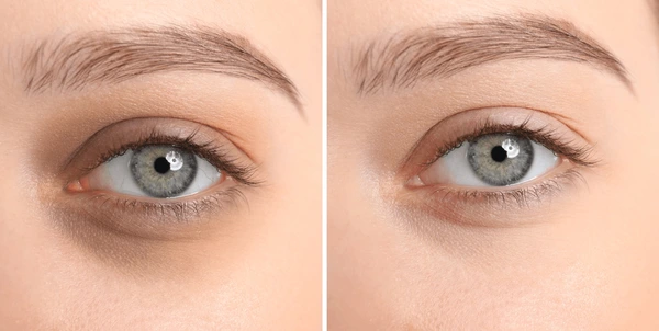 Dark Circle Treatment