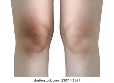 How to get rid of dark knee quickly